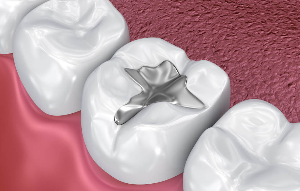 Ashfield Dental Centre, Sydney, NSW Tooth Coloured Fillings - Ashfield Dental Centre
