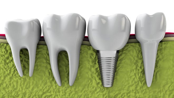 about dental implants