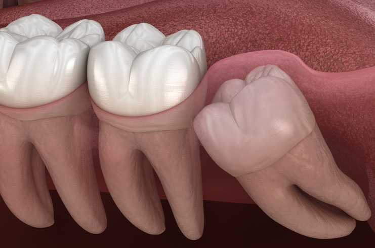 know about wisdom tooth removal