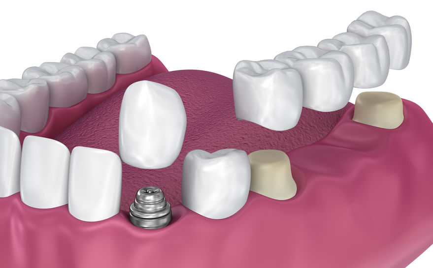 dental crowns and bridges