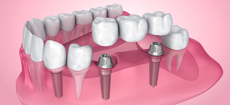 Implants permanent teeth replacement option